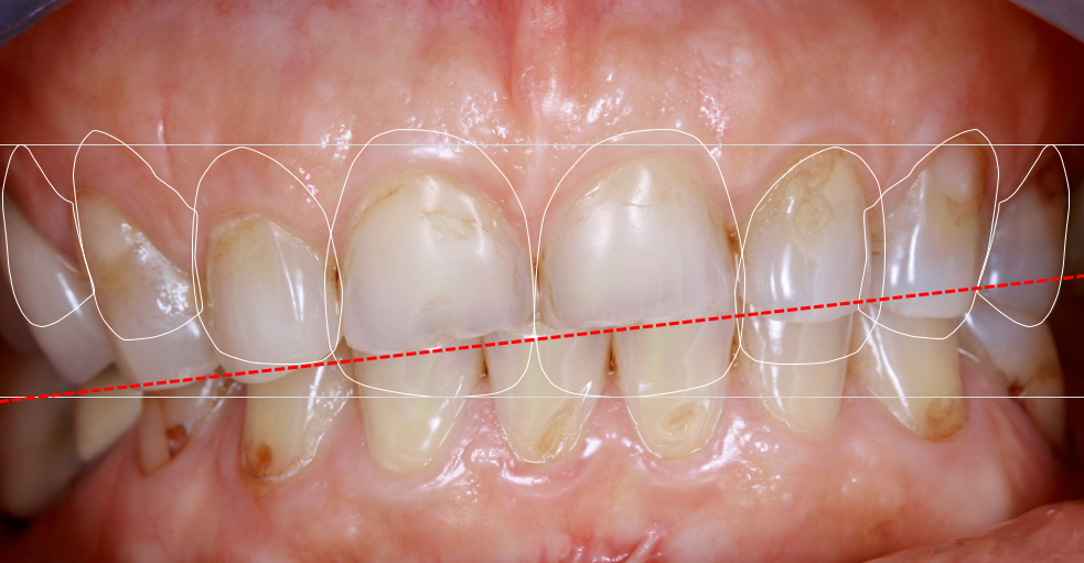 Résultat esthétique d’un traitement dentaire complexe