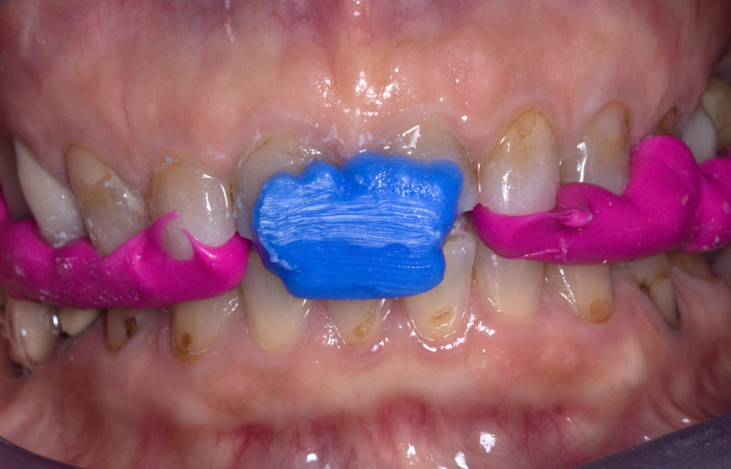 Résultat esthétique d’un traitement dentaire complexe