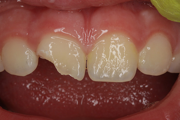 Ill. 1 : Un jeune garçon de 8 ans et demi est tombé sur sa dent 11 contre une balustrade en jouant au loup. Le fragment a malheureusement été perdu.