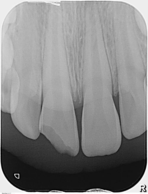Ill. 2 : La radiographie ne révèle ni signe de fracture radiculaire ni lésion alvéolaire.