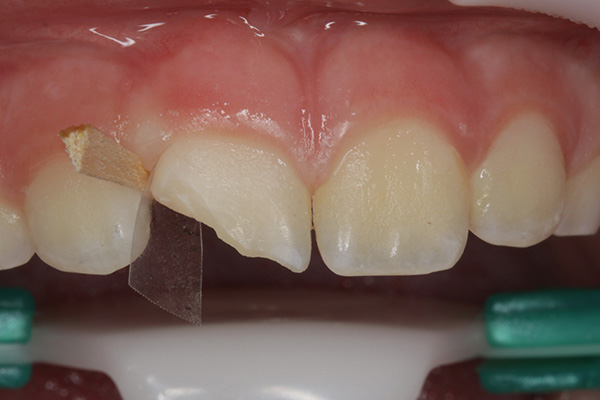 Ill. 3 : Après une mise à sec relative, nous biseautons l'émail avec précaution et fixons une matrice transparente avec une mince clavette en bois.