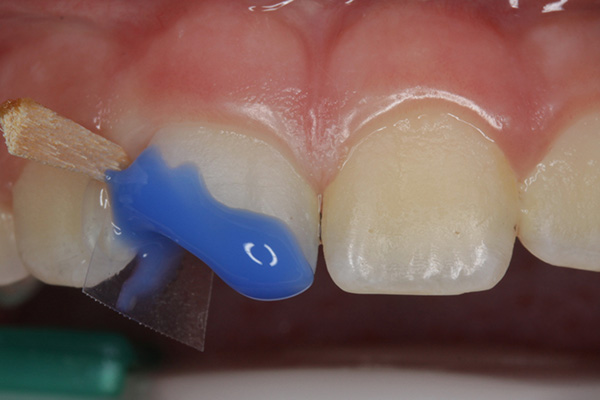 Ill. 4 : Nous adaptons la matrice avec autant de précision que possible avec un composite temporaire fluide (Clip Flow) pour obtenir un moule négatif anatomique (voir Ill. 5). Ce n'est que maintenant que nous mordançons les bords de l'émail, bien au-delà du biseautage, pendant 30 secondes avec de l'acide phosphorique à 36 %.