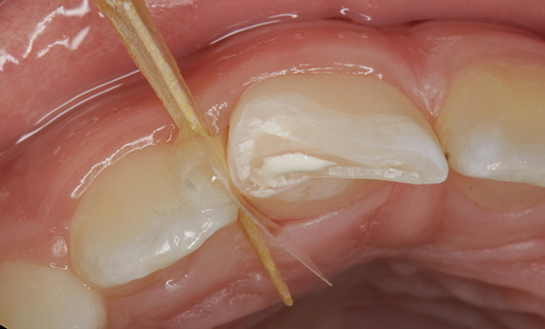 Ill. 5 : Situation après mordançage : on reconnaît clairement l'étendue du défect aussi sur la face incisive.