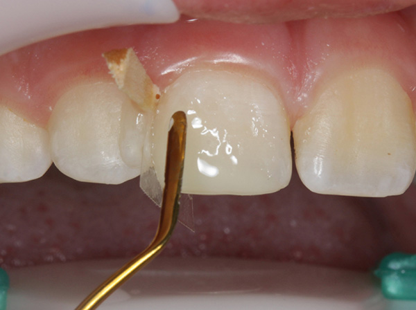 Ill. 8 : Application et modelage de la teinte d'émail à l'aide d'une spatule enrobée.