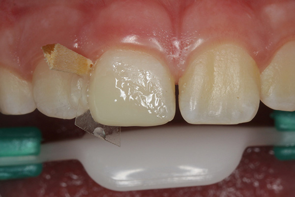 Ill. 9 : Revêtement terminé de l'émail avant...