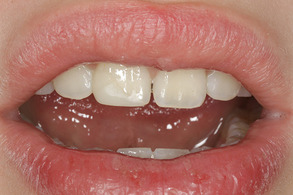 Ill. 12 : Lors du contrôle quatre semaines plus tard, la dent 11 accidentée puis reconstituée ne révèle aucune différence, ni de forme, ni de couleur. Le jeune patient est soulagé, sa mère encore plus.