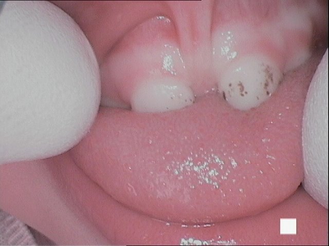 Taches de bactéries chromogènes (et carie sur molaire temporaire, fillette 3 ans)