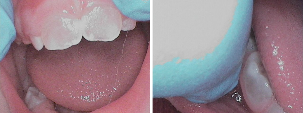 Dentinogenese imparfaite (diagnostic posé à 8 mois, maman atteinte se doutait bien « d’un truc »)