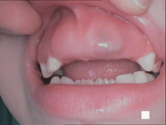 Kyste d’éruption en regard de 21 (fillette 5,5 ans)