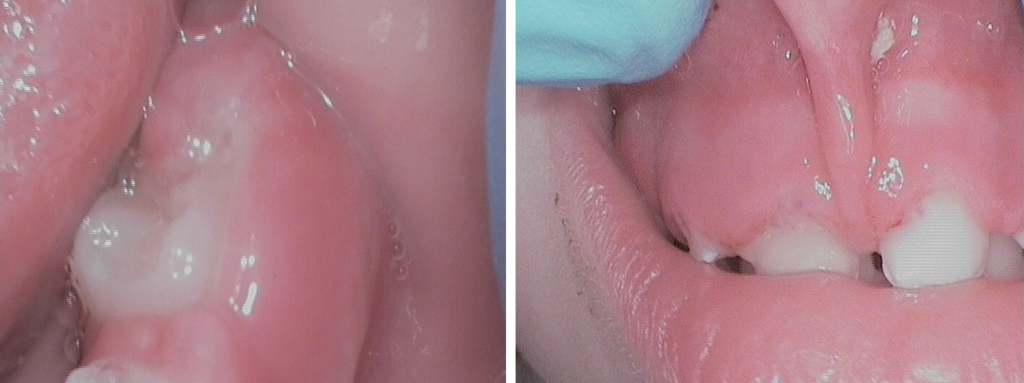 Primo-infection herpétique (enfant 2,5 ans)