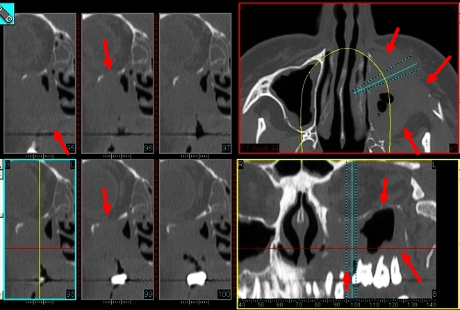 Fig.1 : Carcinome épidermoïde du sinus maxillaire gauche.