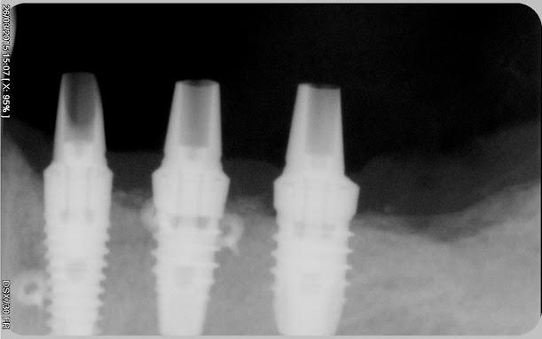 cas clinique - Gestion Parodontale et Prothétique d’une Péri-Implantite chez un patient à haut risque parodontal