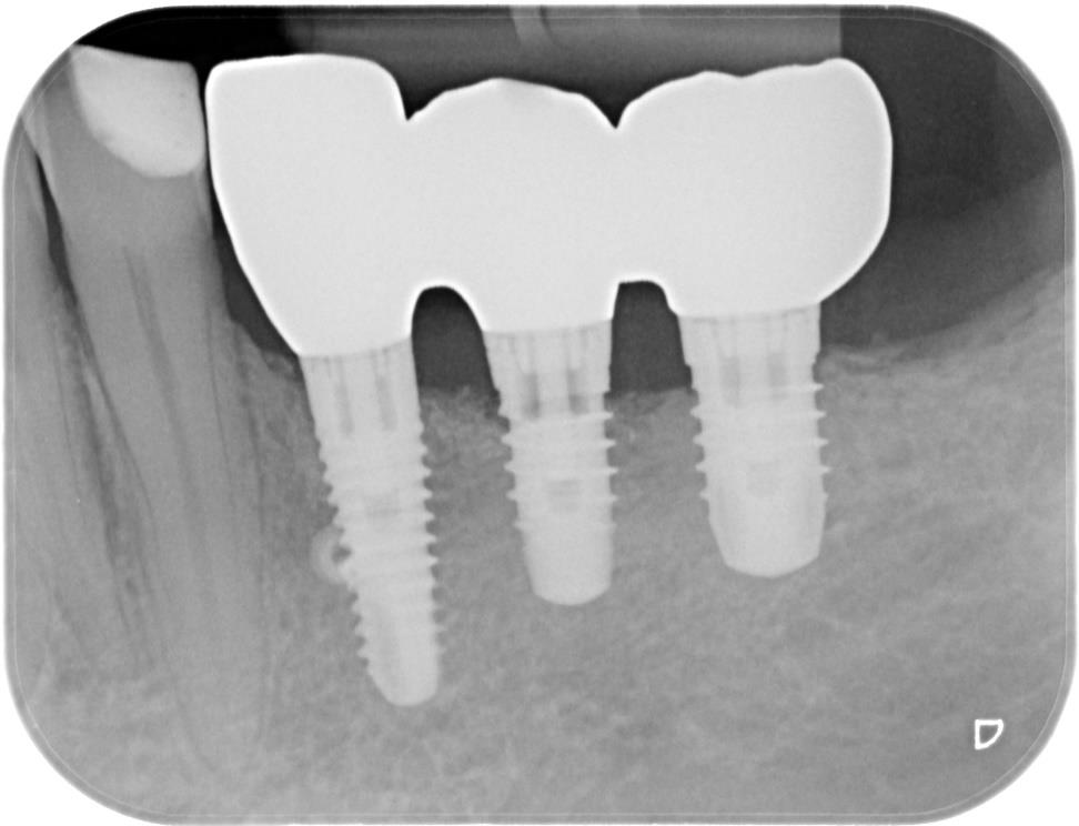 cas clinique - Gestion Parodontale et Prothétique d’une Péri-Implantite chez un patient à haut risque parodontal