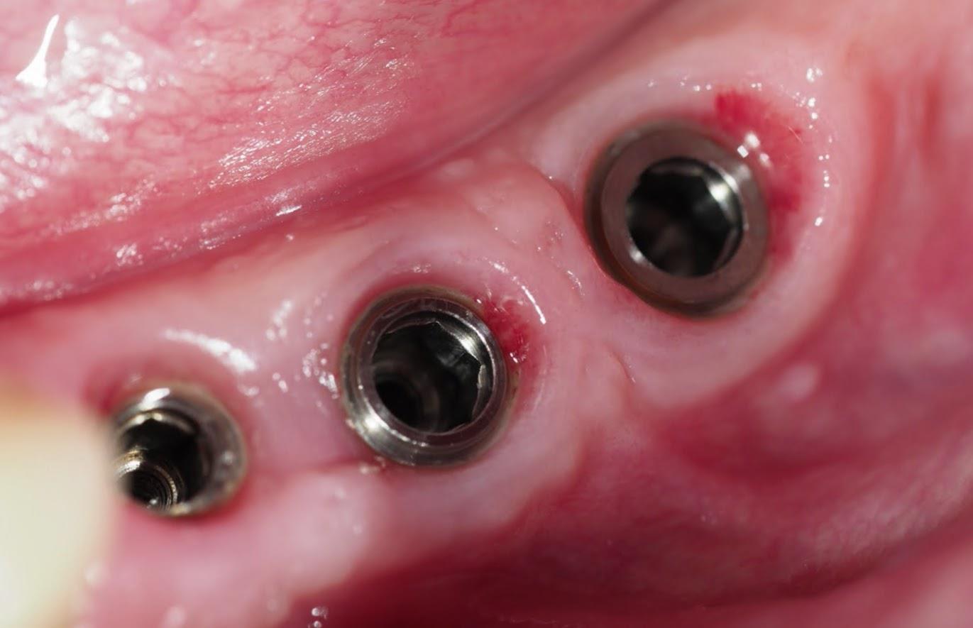 cas clinique - Gestion Parodontale et Prothétique d’une Péri-Implantitechez un patient à haut risque parodontal