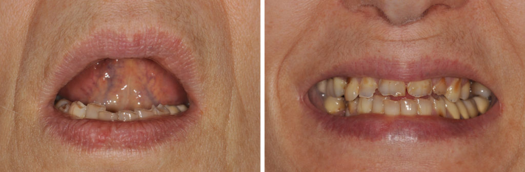 Fig. 4a, 4b : Evaluation de l’exposition des dents, lèvres au repos et lors du sourire maximal.