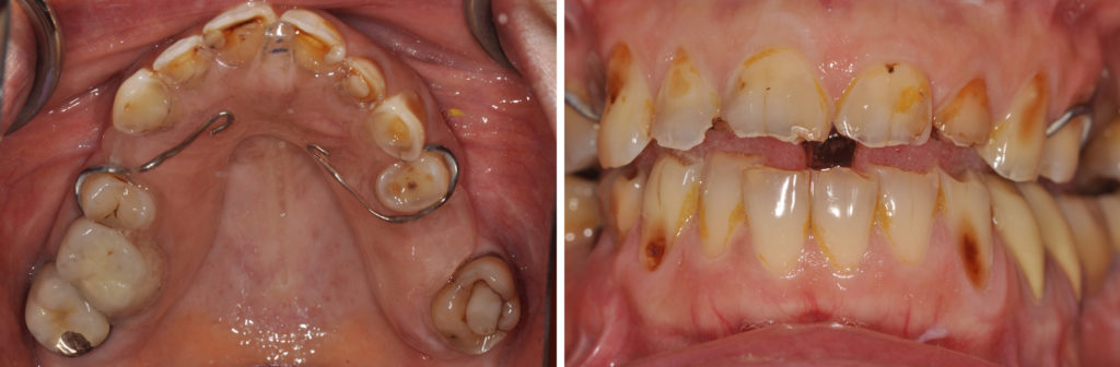 Fig, 5a, 5b : Port pendant 6 semaines d’une orthèse de déprogrammation occlusale afin d’obtenir une position articulaire de référence à la future reconstruction.