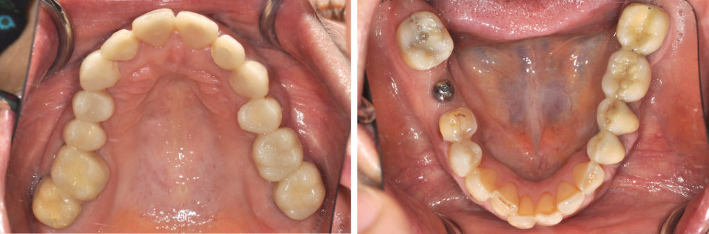 Fig. 6a, 6b, 6c : Mock-up en place pour tester les nouveaux paramètres esthétiques et fonctionnels.