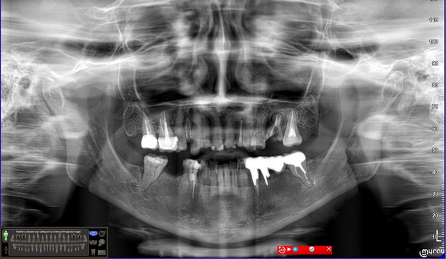 Fig. 3 : Radio panoramique initiale