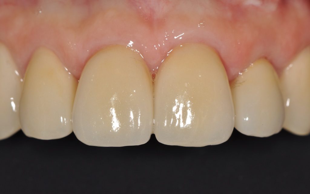 Fig. 7a, 7b, 7c : Chirurgie parodontale d'alignement des collets.