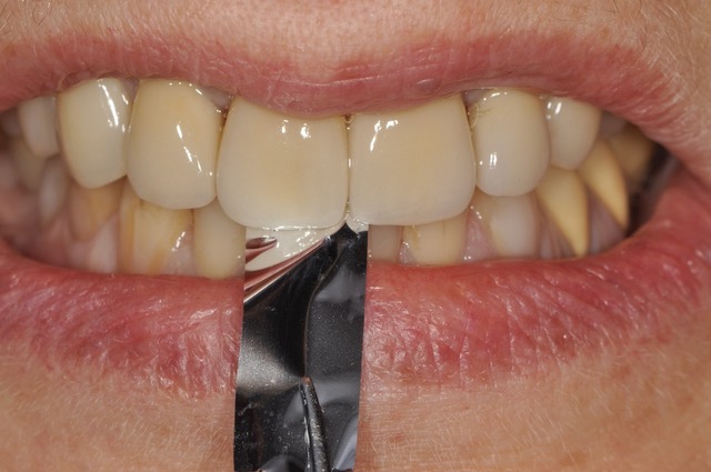 Fig. 9a, b et c : Equilibration occlusale.