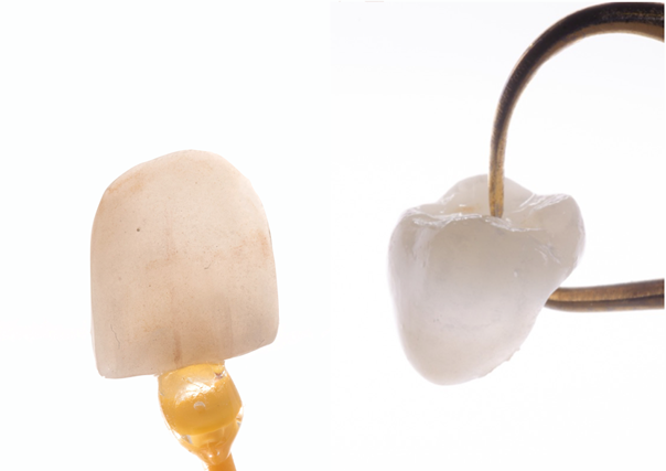 Facette antérieure et facette postérieure ou Veneerlay.