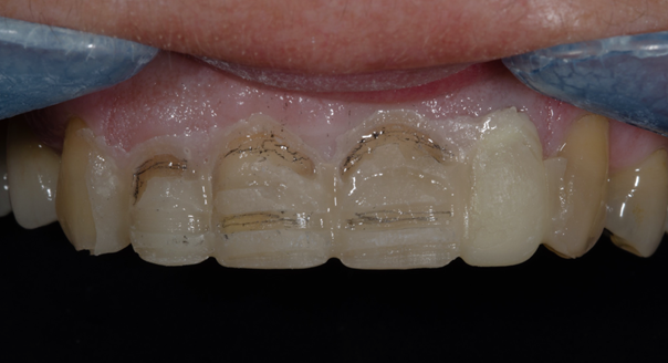 Marquage de profondeur à travers un mock-up.