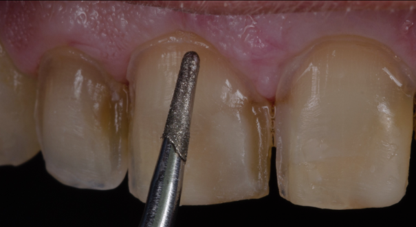 Insert ultra sonore pour finition des préparations (Perfect margin, Acteon).