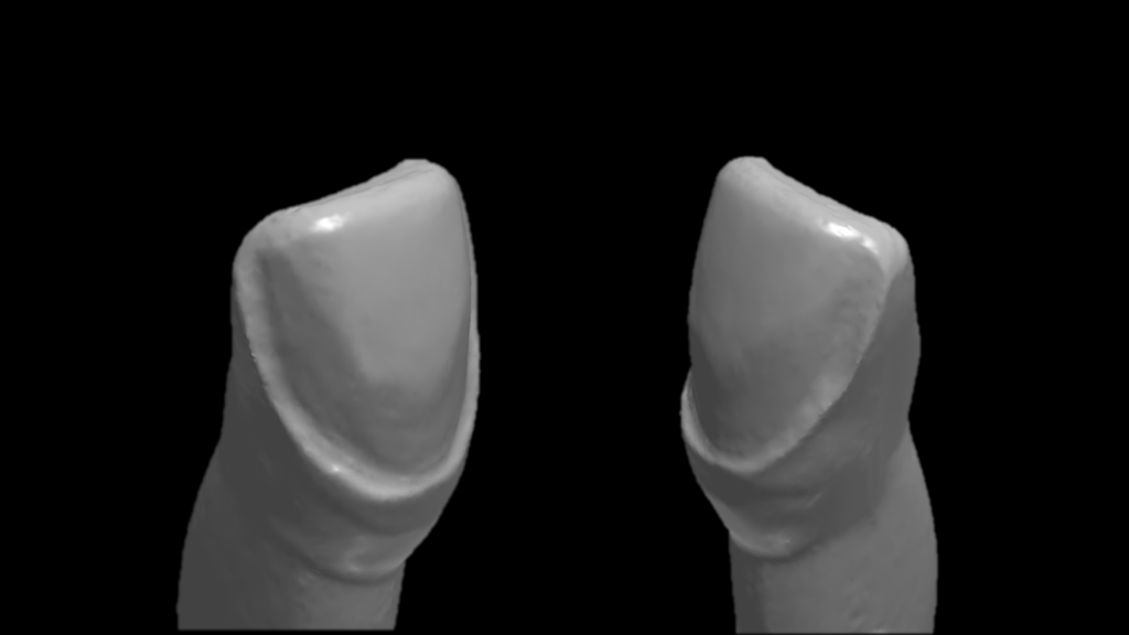 Vue 3D d'une préparation remplaçant le bord libre.