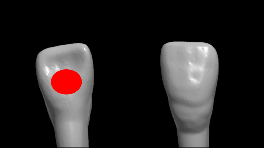 Zone défavorable pour la finition de préparation : le cingulum.