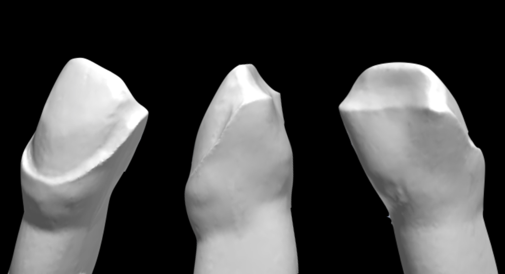 Facette avec retour incisal.