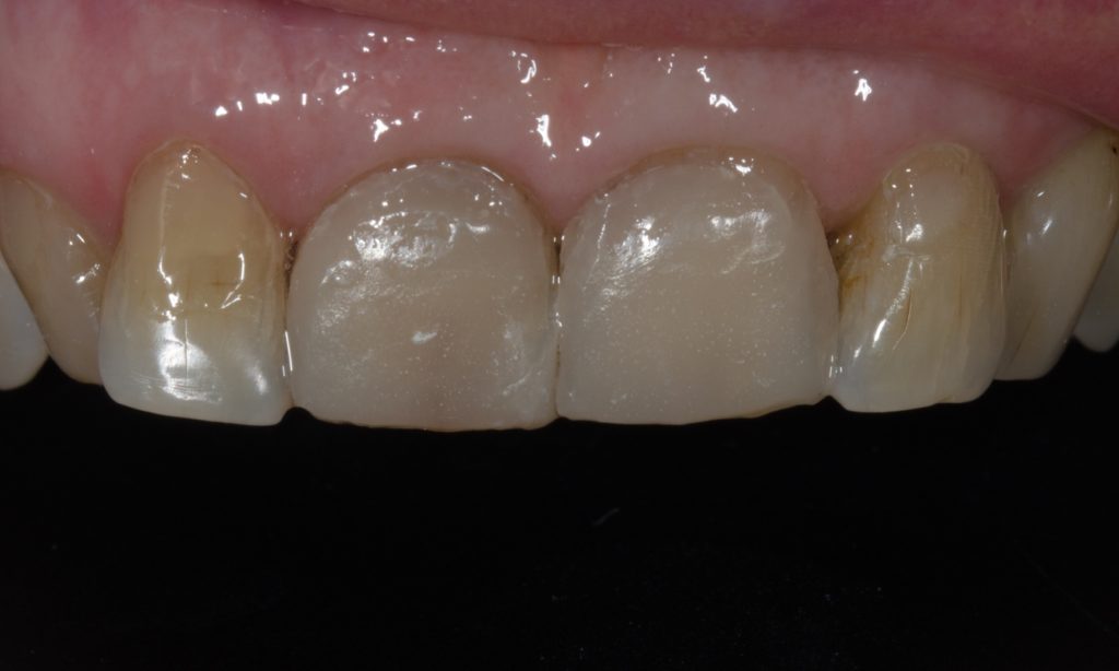 Facettes provisoires collées en bouche.