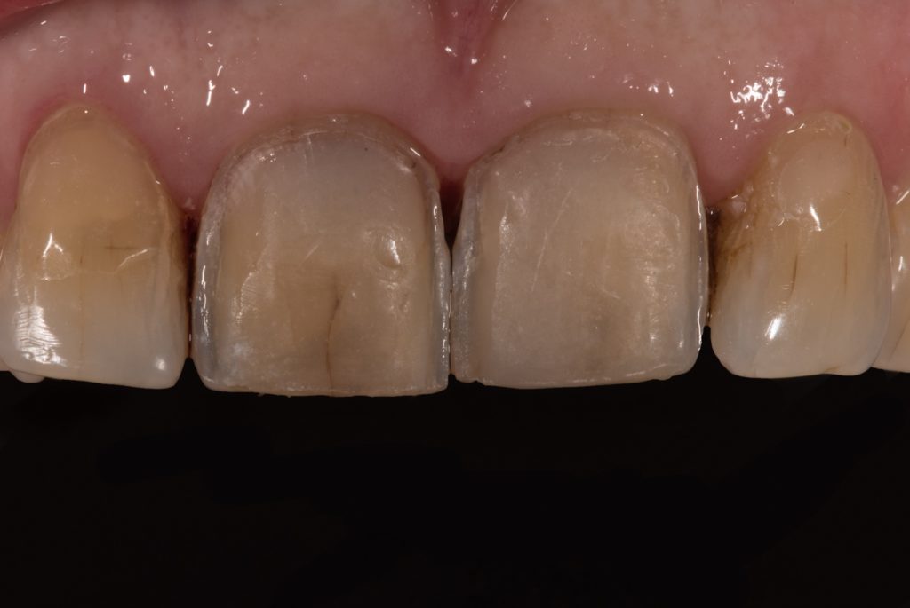 Les dents préparées.