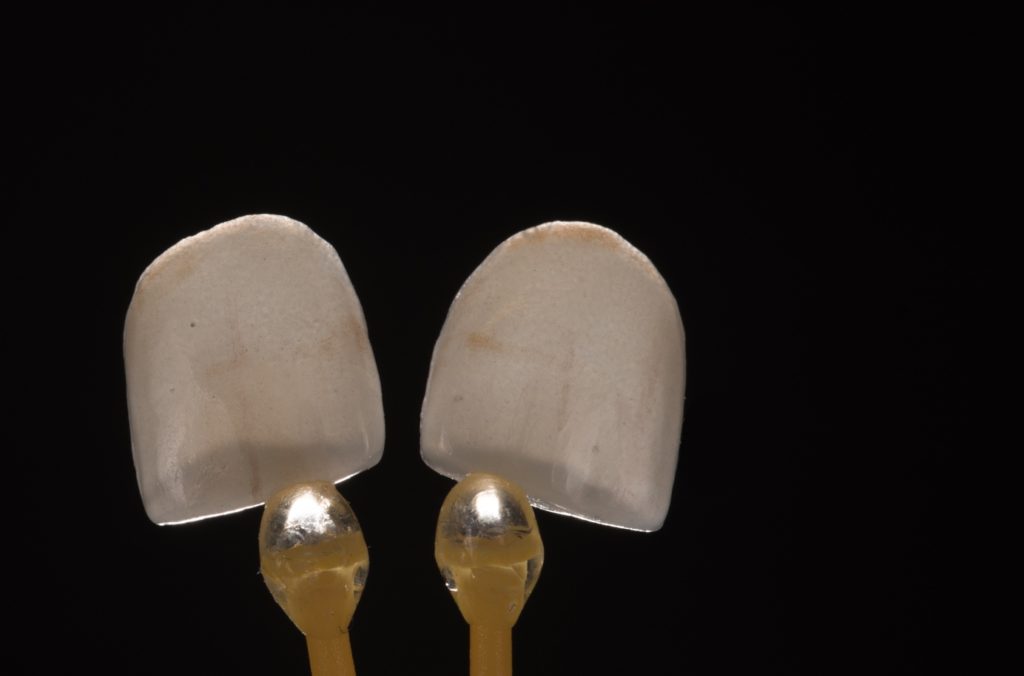 La faible épaisseur des deux facettes est objectivée par la translucidité de la céramique.