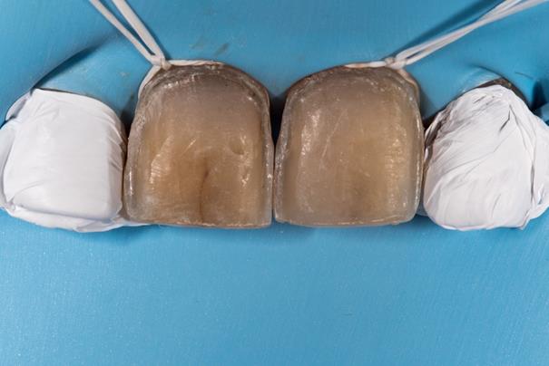 Mise en place du champ opératoire.