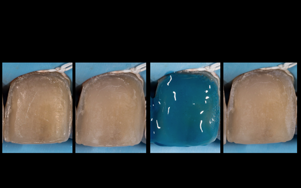 Conditionnement des surfaces dentaires.