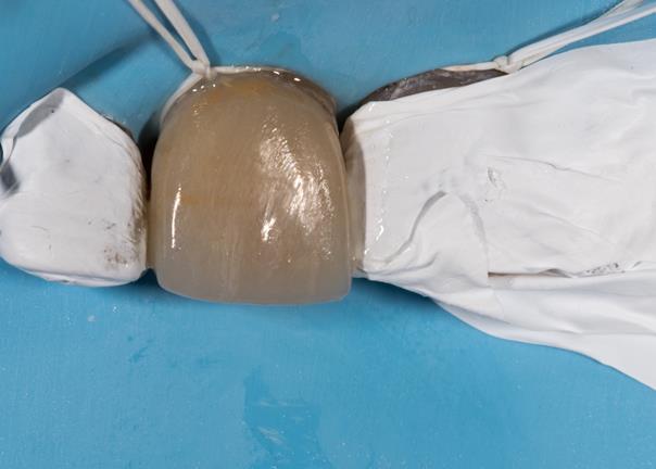 Mise en place de la facette sur 11.