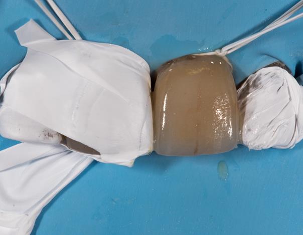 Mise en place de la facette sur 21.