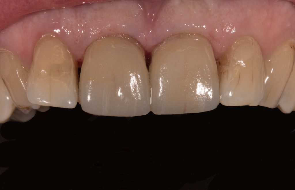 Résultat en immédiat après dépose du champ opératoire.