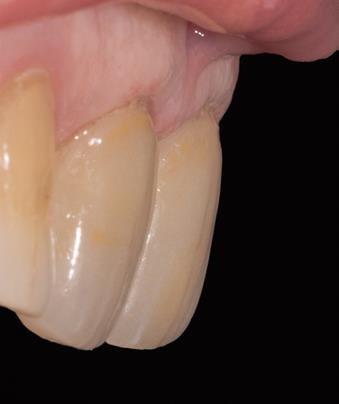 Contrôle des profils d’émergence.