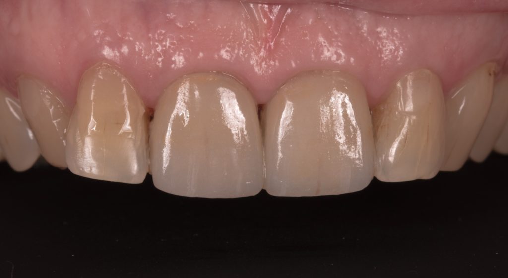 Résultat à 3 semaines.