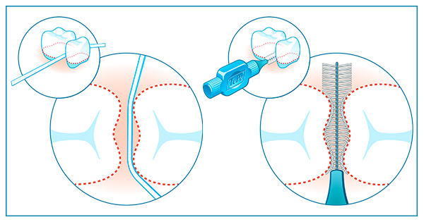 brossettes interdentaires et fil dentaire TEPE