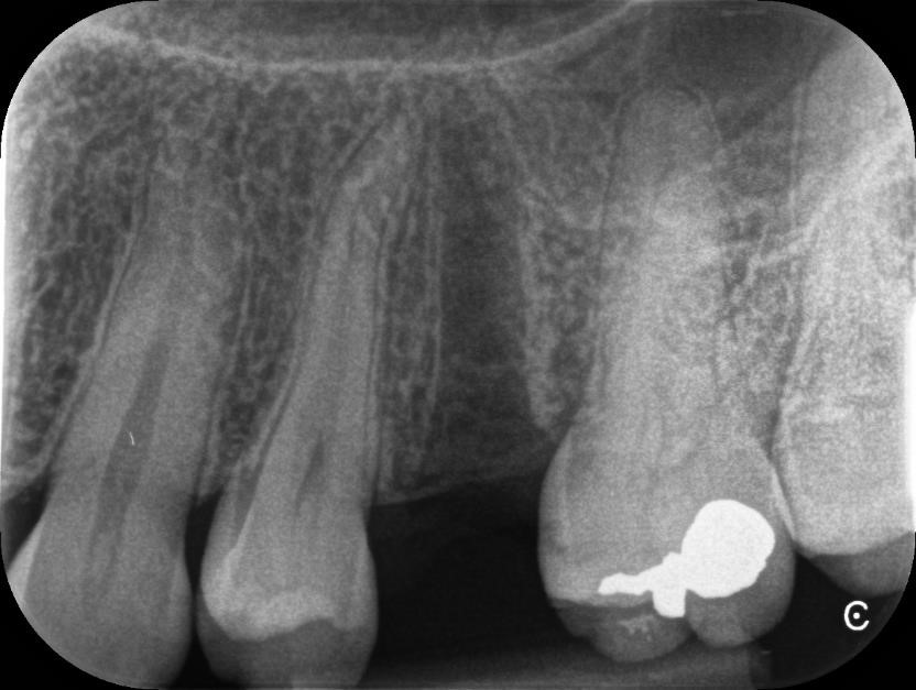 Figure 1 : Radiographie rétro-alvéolaire post-extractionnelle