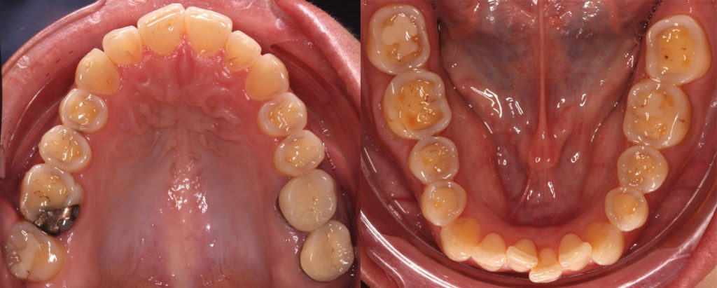 Fig. 1 : L'usure des dents postérieures met en évidence la dentine et le bandeau d'email des dents