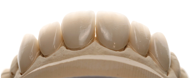 Fig. 14 : Facette Emax stratifiées 