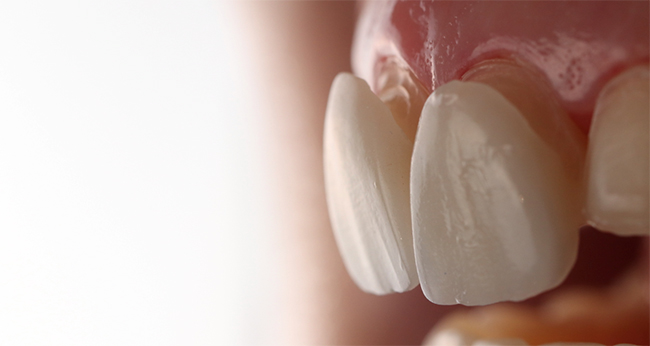 Fig. 15 : Essayage des facettes à l’aide d'une pâte Try-in