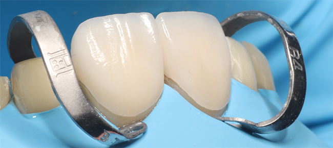 Fig. 16 : Collage des facettes sous champ opératoire