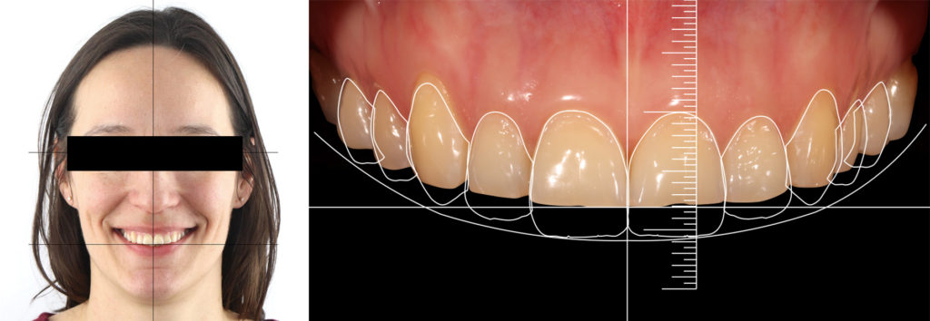 Fig. 3 : Analyse des plans du visage et mise en place de la stratégie prothétique en fonction du smile design 