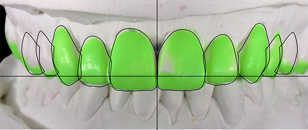 Fig 4. Wax up en fonction du smile design et des consignes du praticien 