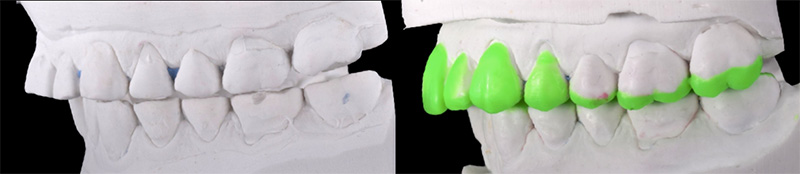Fig 5 : Réhaussement de la DV de 5mm et montage des cires en fonction des futurs éléments prothétiques 