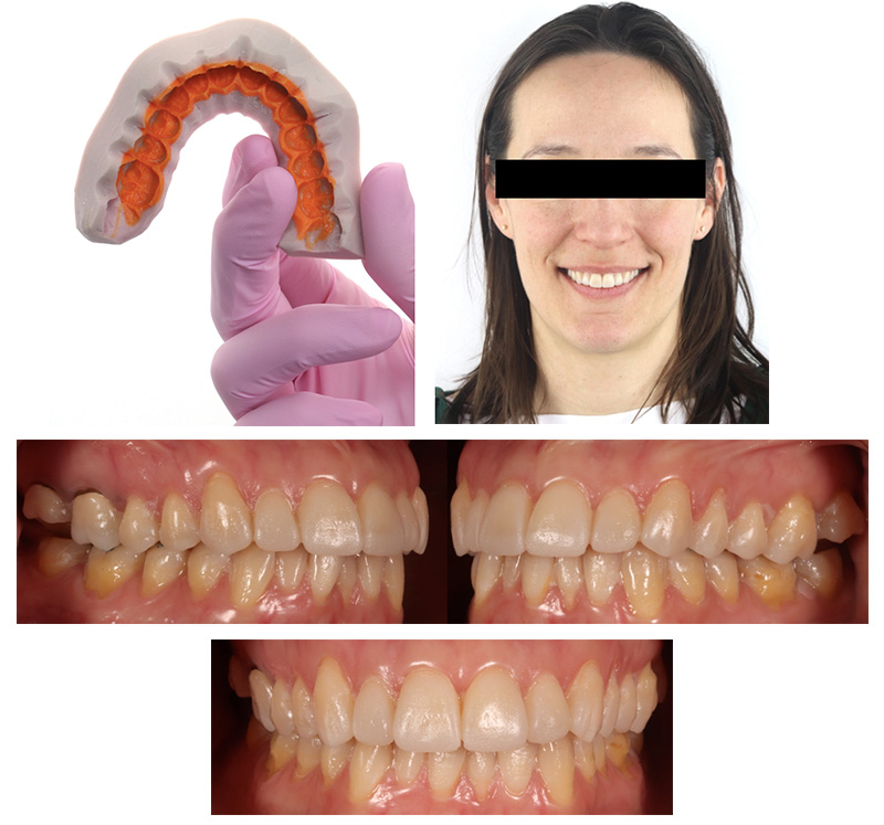 Fig. 6 : Essayage du Mock-up en bouche et validation de l’esthétique avec le patient. Veuillez noter que la résine au niveau de la 2ème molaire a été retirée afin d’objectiver l’importance du rehaussement de la nouvelle DV